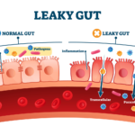 leaky gut symptoms causes and how to heal it